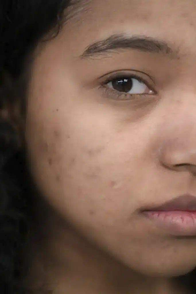 post procedure skincare to prevent pigmentation